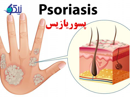 پسوریازیس