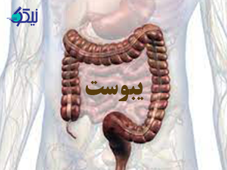چگونه یبوست را در منزل سریع درمان کنیم؟
