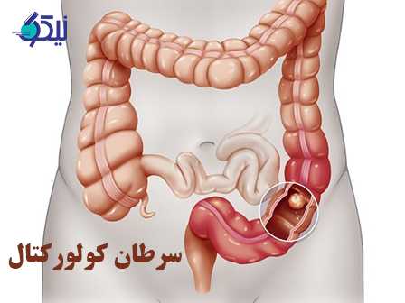 علائم اولیه سرطان کولورکتال (روده بزرگ) چیست؟