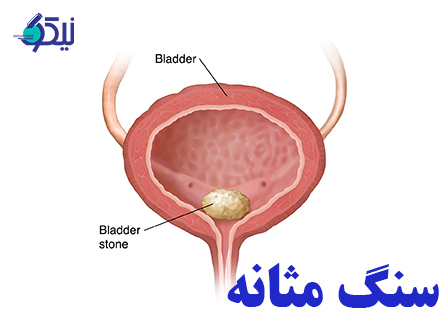 چگونه سنگ‌مثانه را درمان کنیم؟