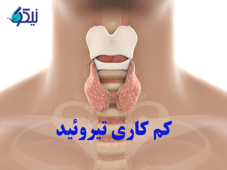 کم کاری تیروئید