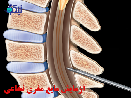 هر آنچه که باید از آزمایش مایع مغزی نخاعی بدانیم. (قسمت اول)