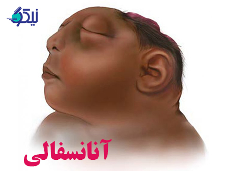 از آنانسفالی چه می دانید؟