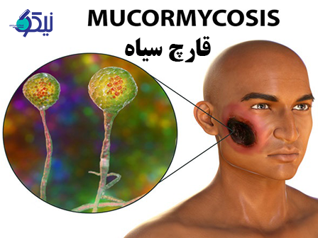 آیا قارچ سیاه از عوارض کرونا می باشد؟