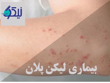 بیماری لیکن پلان چگونه تشخیص داده می شود؟