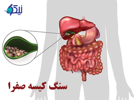 کيسه صفرا چيست؟(روش درمان سنگ کيسه صفرا چيست؟)