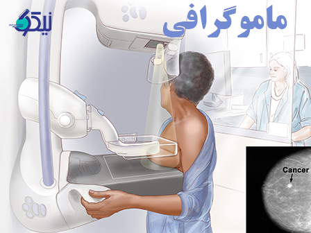 ماموگرافي در آزمايشگاه سرطان پستان چگونه انجام مي شود؟