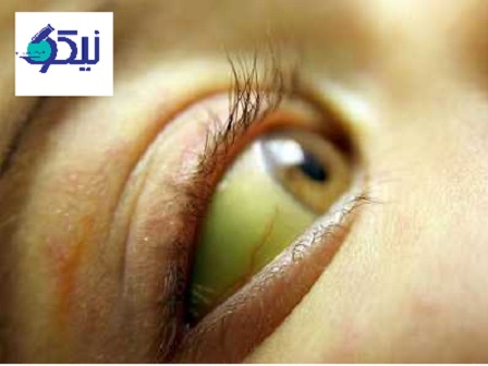 سندرم ژیلبرت چیست؟
