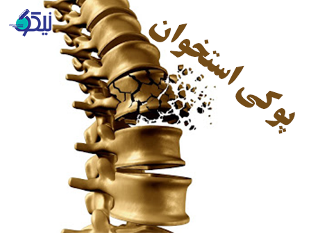 پوکی استخوان یا استئوپروز