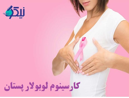 کارسینوم لوبولار پستان چه علائمی دارد؟