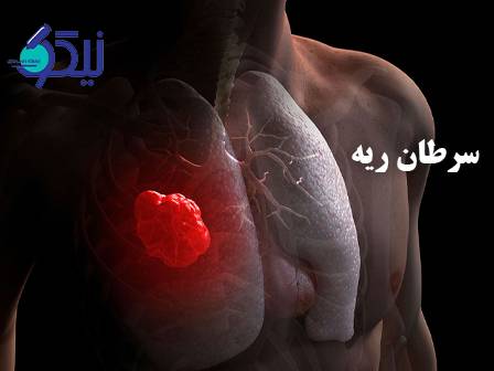 سرطان ریه؛ قاتل خاموشی که دیر تشخیص داده می‌شودر