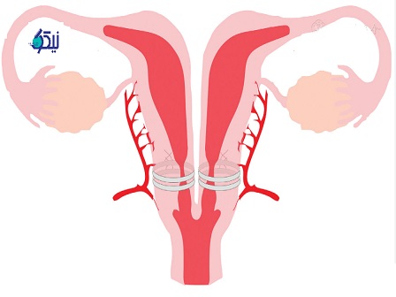 آیا رحم دوگانه بر باروری تاثیر دارد؟