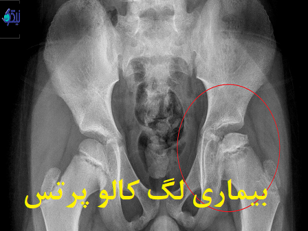 بیماری لگ کالو پرتس چیست و چه علائمی دارد؟
