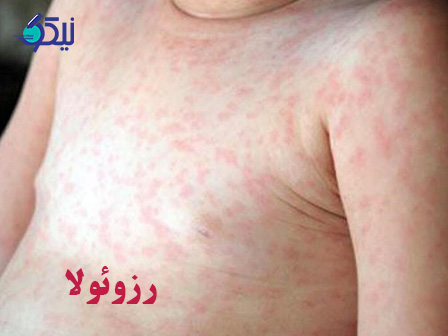 روزئولا چیست؟