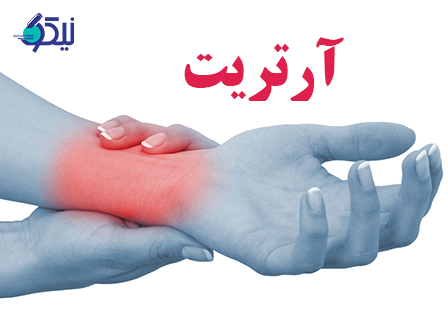 آرتریت