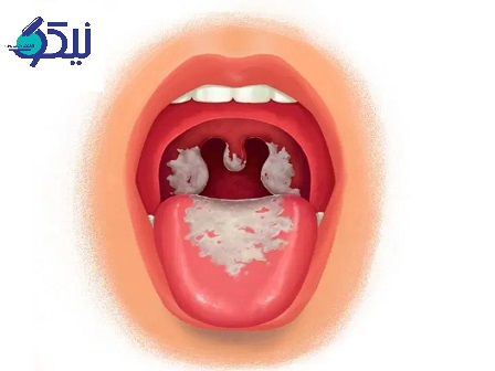 دیفتری چیست؟