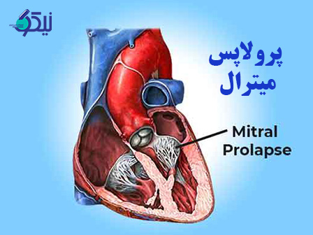 افتادگی دریچه میترال یا پرولاپس میترال چیست؟