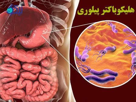 هلیکوباکتر پیلوری چگونه تشخیص داده می شود؟