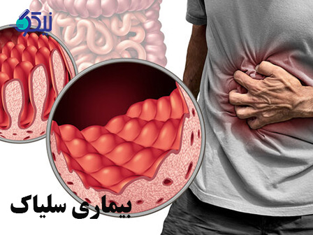 بیماری سلیاک چه علائمی دارد؟