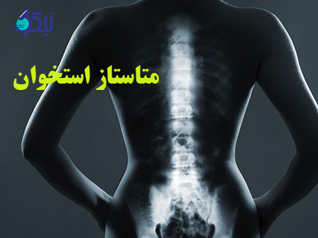 متاستاز استخوان چیست و چه زمانی رخ می دهد؟