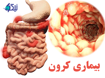 از بیماری کرون چی میدانید؟